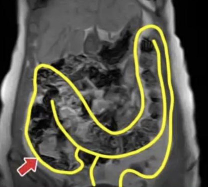 Kiwi fruit relieves a Japanese woman with 30year constipation problem