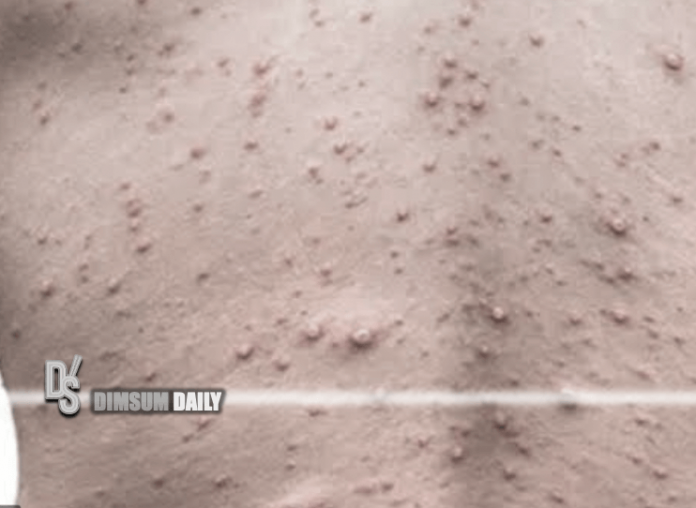 First case of monkeypox recorded in Chongqing - Dimsum Daily