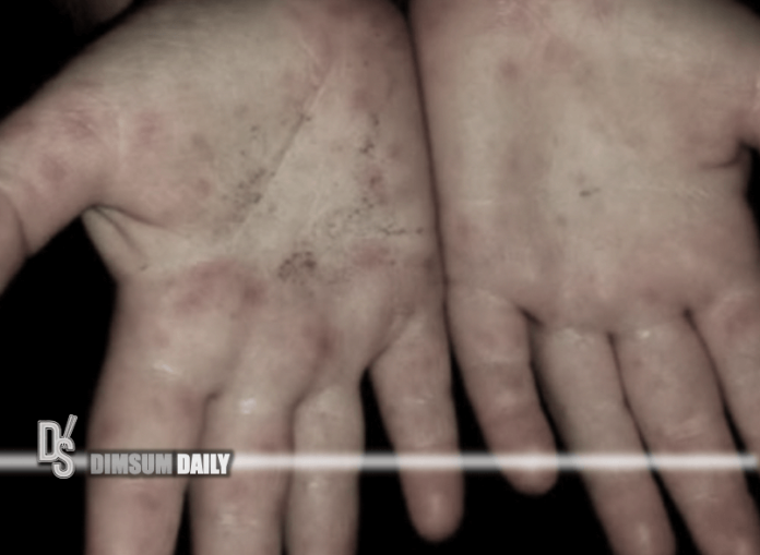 Outbreak of hand, foot, and mouth disease investigated at child care centre in Causeway Bay