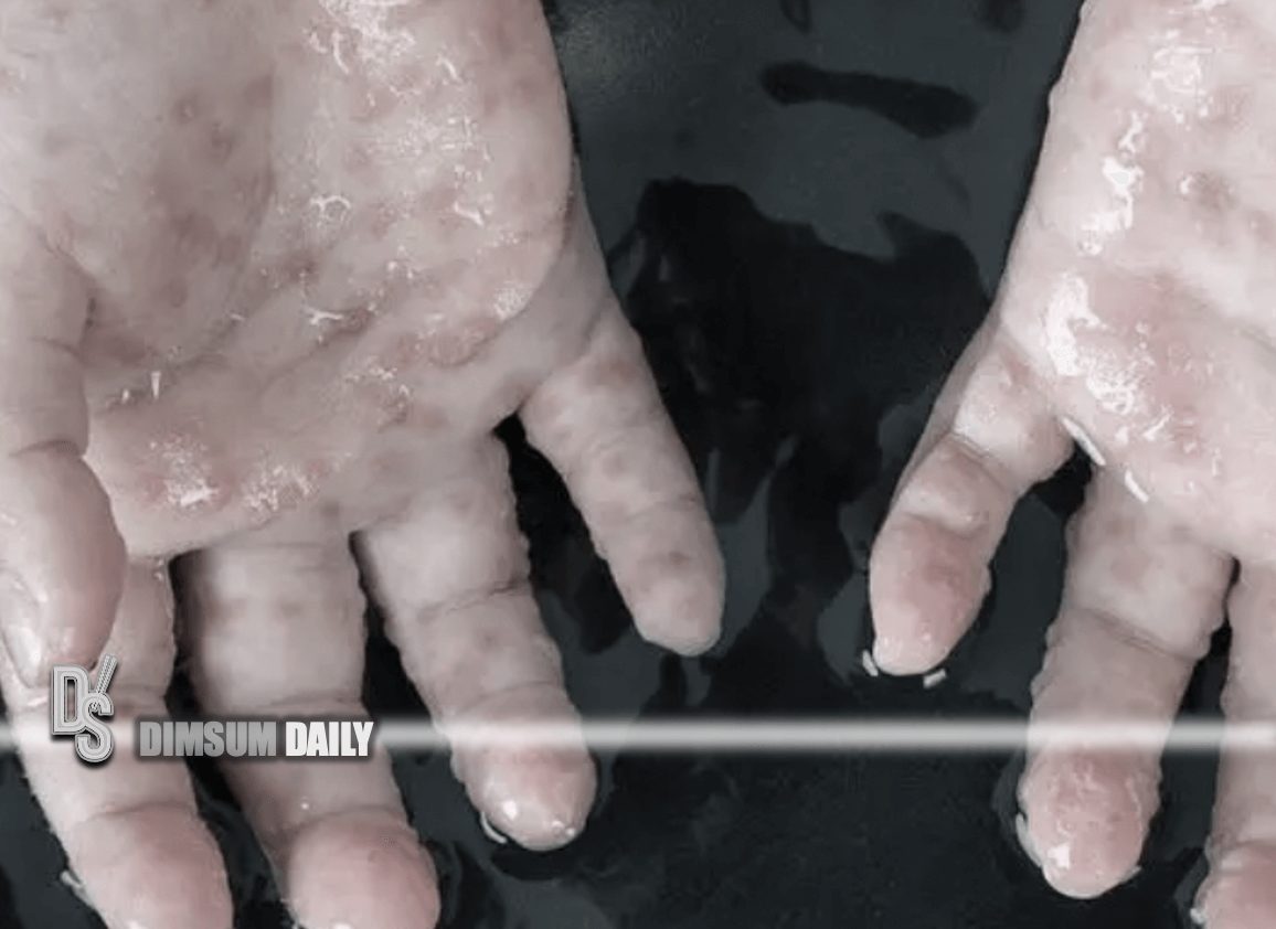 Hong Kong investigates confirmed case of Monkeypox involving 54-year ...