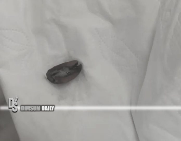 Man suffers for nine years after peanut lodged in lung, misdiagnosed as pneumonia Dimsum Daily