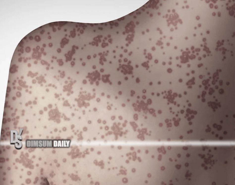 Taiwan raises Japan travel alert over imported measles case